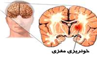 فشار خون بالا، عامل مهم خونریزی های مغزی